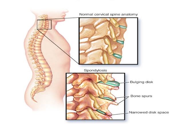 Pathology of cervical spondylosis