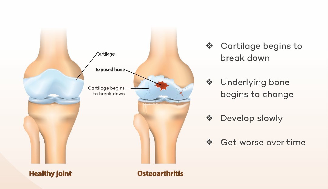 Understanding Arthritis: Causes, Symptoms, and Advances in Treatment